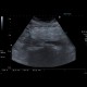 Mesenterial lipodystrophy on ultrasound: US - Ultrasound